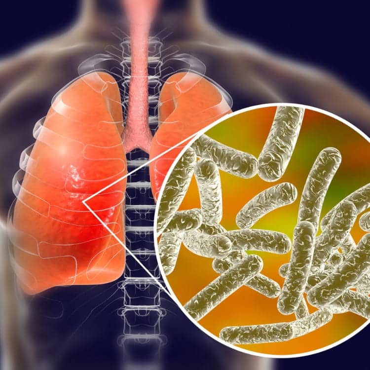 foto legionella micro pulmonar